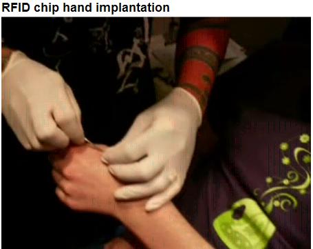 RFID handchip implant